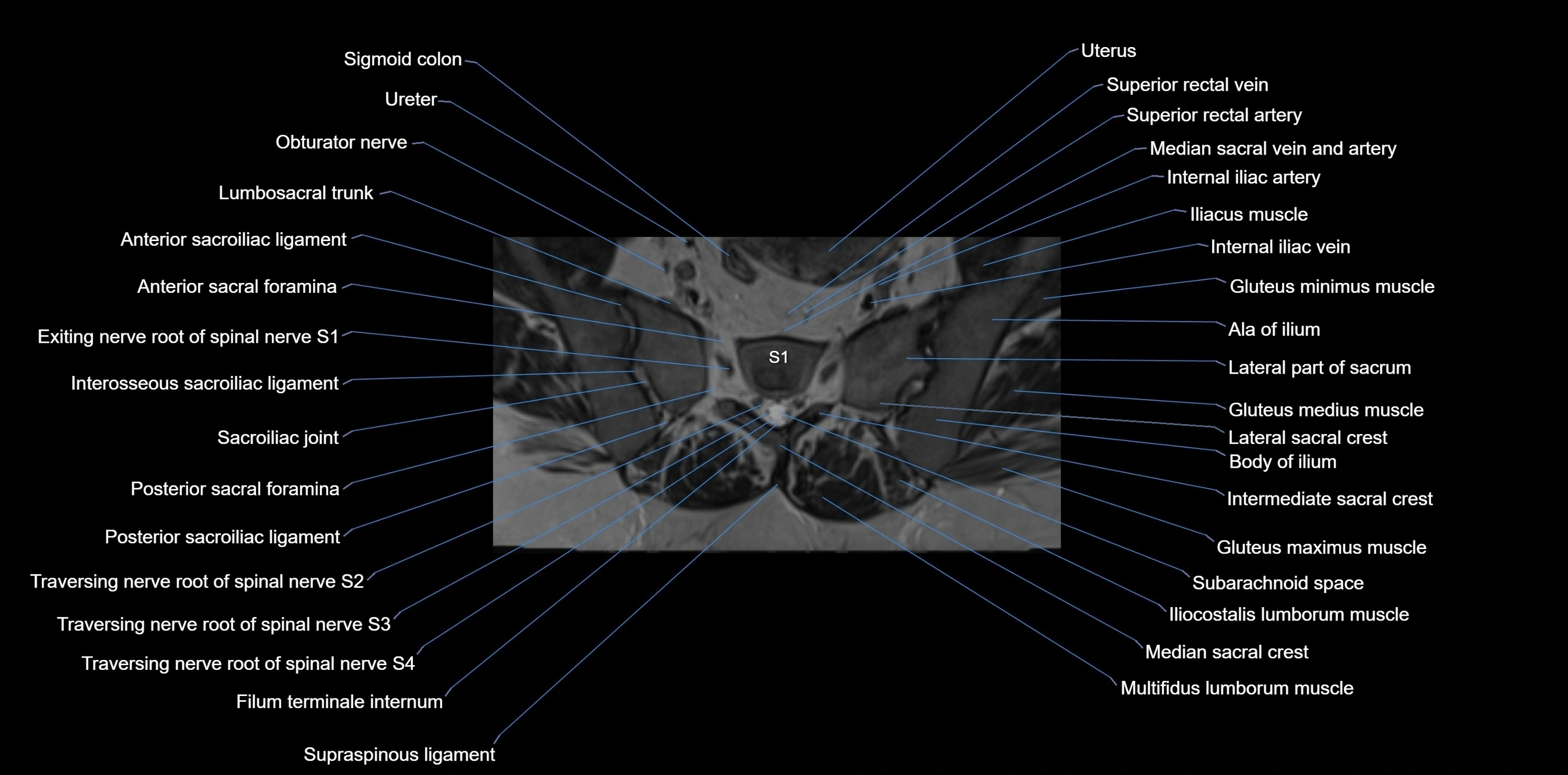 MRI sacrum, coccyx and sacroiliac joint axial cross sectional anatomy 3T  radiology  image-img-00001-00019.webp